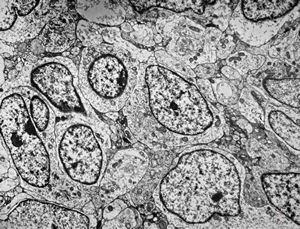 F,8y. | medulloblastoma F,8y. | medulloblastoma